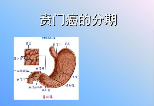 賁門(mén)癌手術(shù)體位注意事項(xiàng),賁門(mén)癌的飲食注意事項(xiàng),賁門(mén)癌術(shù)前注意事項(xiàng)