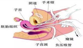無痛人流流程和注意事項(xiàng),無痛人流后注意事項(xiàng),無痛人流當(dāng)天注意事項(xiàng)
