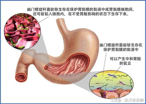 吃治療幽門(mén)桿菌的藥注意事項