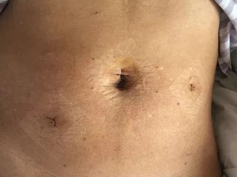 腹腔鏡疝氣修補術(shù)后的注意事項