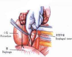 賁門(mén)癌手術(shù)后注意事項(xiàng)