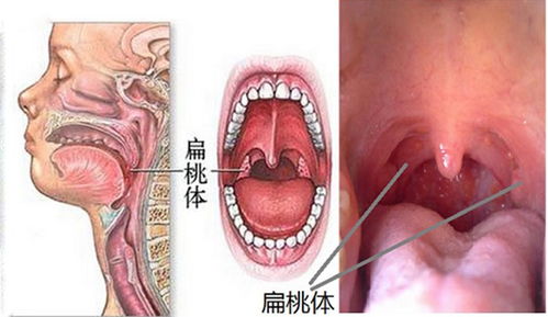 扁桃體摘除手術(shù)后注意什么,腺樣體和扁桃體摘除手術(shù)后的注意事項,扁桃體摘除手術(shù)術(shù)后注意事項