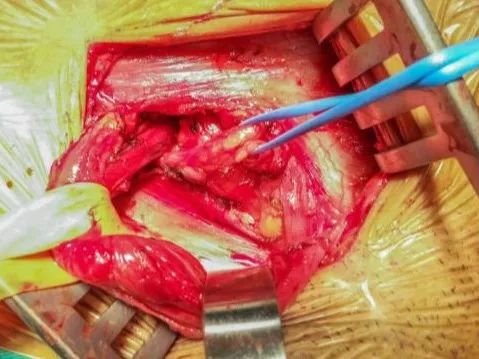腹腔鏡疝氣手術(shù)后注意事項,做完腹腔鏡疝氣手術(shù)后注意事項,小兒腹腔鏡疝氣手術(shù)后注意事項