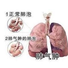 肺氣腫,應注意,事項