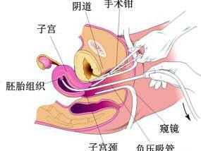 引產(chǎn)手術(shù)術(shù)前注意事項,引產(chǎn)手術(shù)后需要注意事項,引產(chǎn)注意事項大全