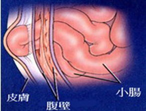 疝氣手術(shù)的注意事項