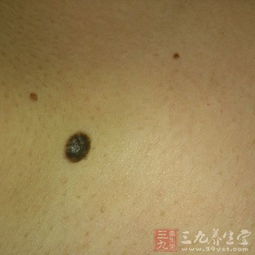 去完黑痣注意事項