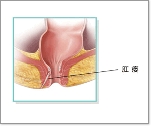 艾滋病可以做肛瘺手術(shù)嗎,艾滋病肛瘺去哪里手術(shù),艾滋病肛瘺手術(shù)多久恢復