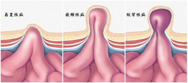 7歲小孩做疝氣手術(shù)注意事項