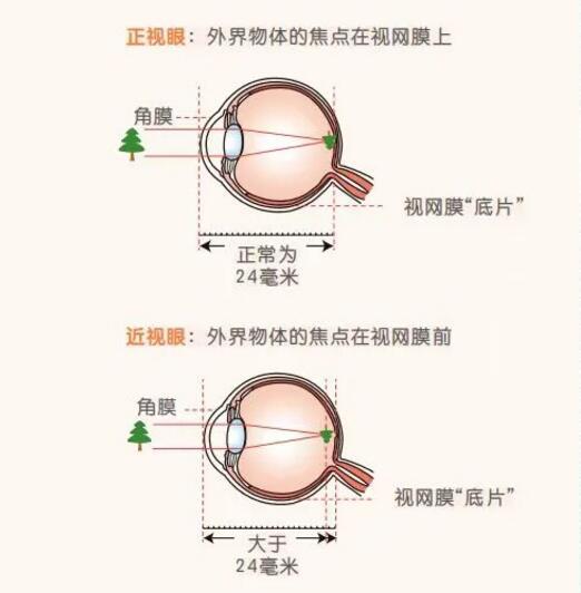 孩子散瞳后注意事項