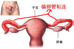 輸卵管粘連術(shù)后注意事項