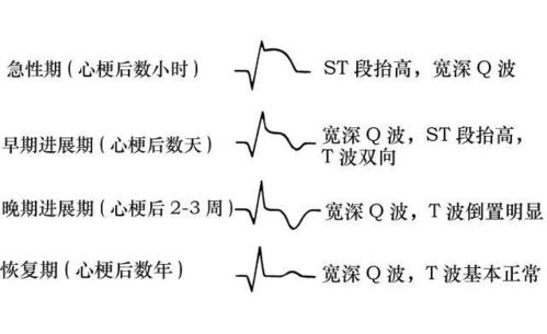 心電圖,要注意,事項,檢查