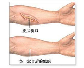 瘢痕注意事項