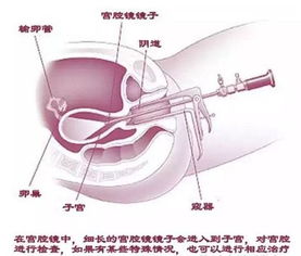 試管,注意事項,宮腔鏡