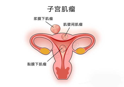粘膜下子宮肌瘤宮腔鏡手術(shù)后注意事項(xiàng)