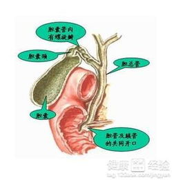 膽結(jié)石,注意事項(xiàng),發(fā)生