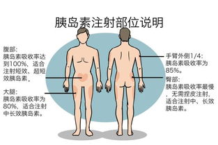寫(xiě)出胰島素注射的注意事項