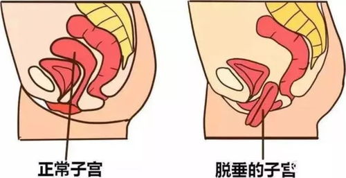 術(shù)后,修補,子宮,注意事項