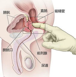 前列腺癌化療注意事項(xiàng)