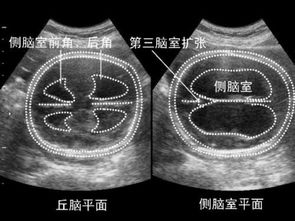 注意事項,早孕