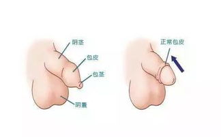 包皮長自己天天注意事項才能不長