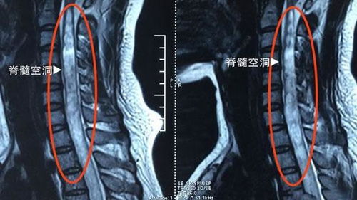 造影,脊髓,術后,注意事項