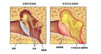 患急性中耳炎注意事項
