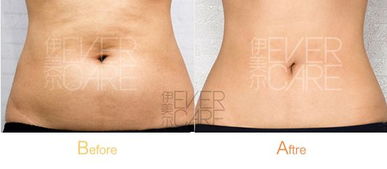 腰部吸脂術(shù)后注意事項