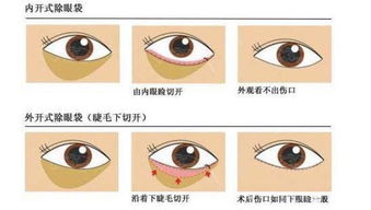 眼袋,注意事項,手術(shù)