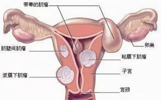 子宮肌瘤患者月經(jīng)期注意什么,子宮肌瘤患者日常注意事項,子宮肌瘤患者性生活注意事項