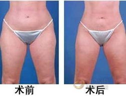 術(shù)后,腰部,注意事項,吸脂