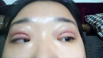 全切雙眼皮術(shù)后注意事項,做完全切雙眼皮注意事項有哪些,全切雙眼皮注意事項有哪些