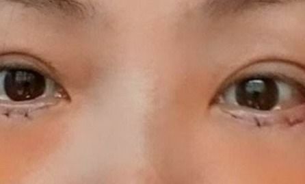 割下眼袋的注意事項