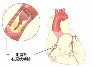 心血管,支架,注意事項