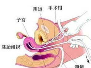 做完刮宮術(shù)后注意事項