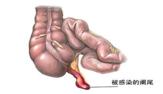 惡性闌尾炎手術(shù)后注意事項