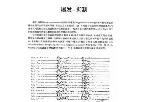 正常腦電圖基礎知識