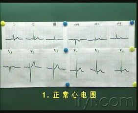 心電圖基礎知識教學(xué)